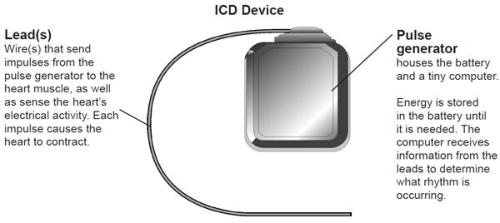 Internal Cardio defibrillator