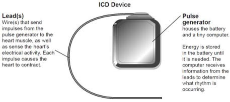 Internal Cardio defibrillator